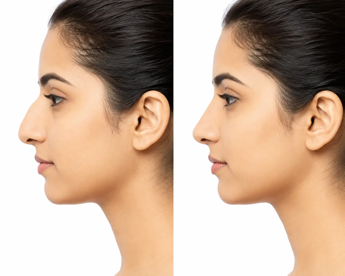 Nose correction services in Rajkot