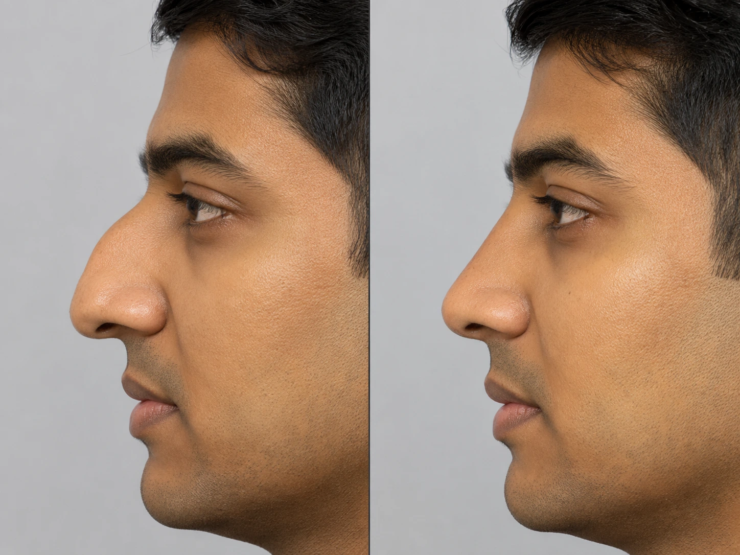 Functional rhinoplasty assessment for breathing concerns