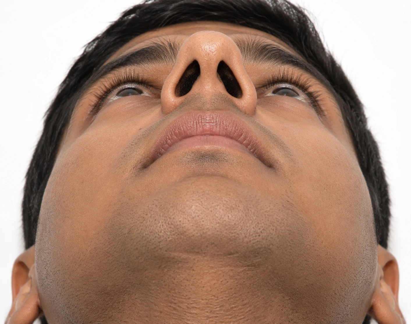 Septorhinoplasty treatment planning