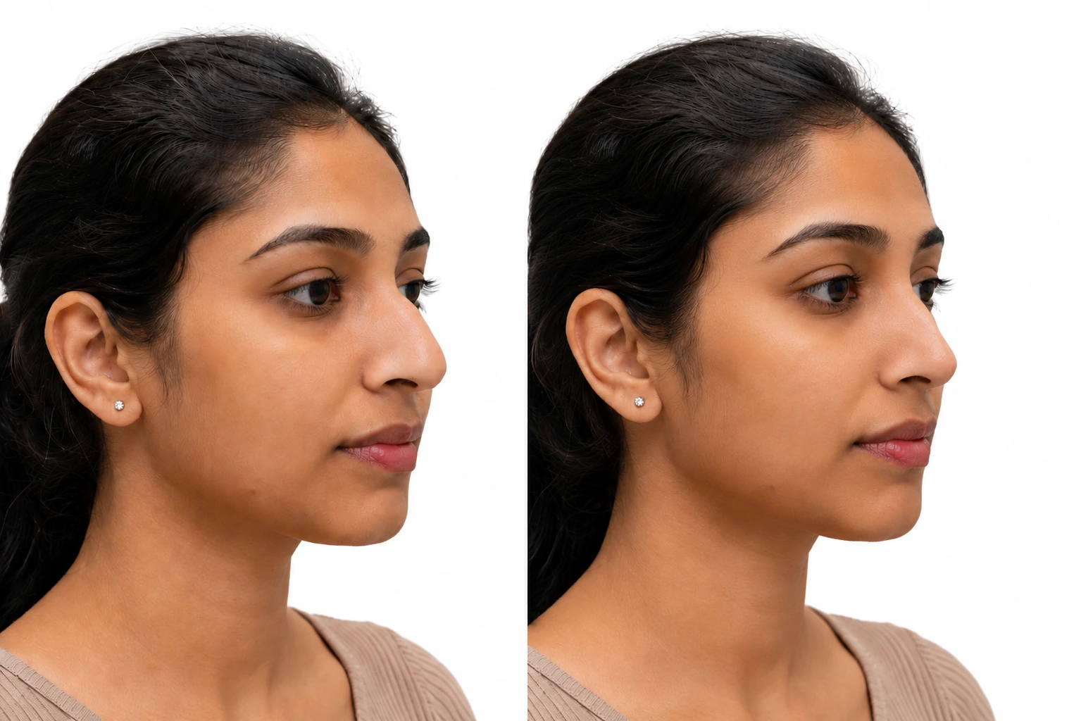 Rhinoplasty and nose reshaping services in Rajkot