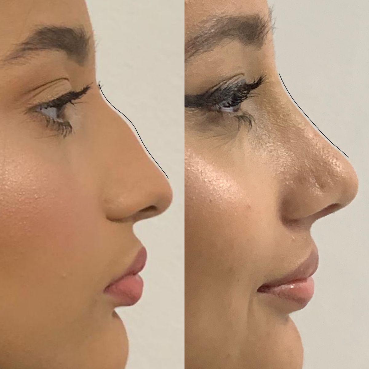 Patient considering personalised rhinoplasty surgery