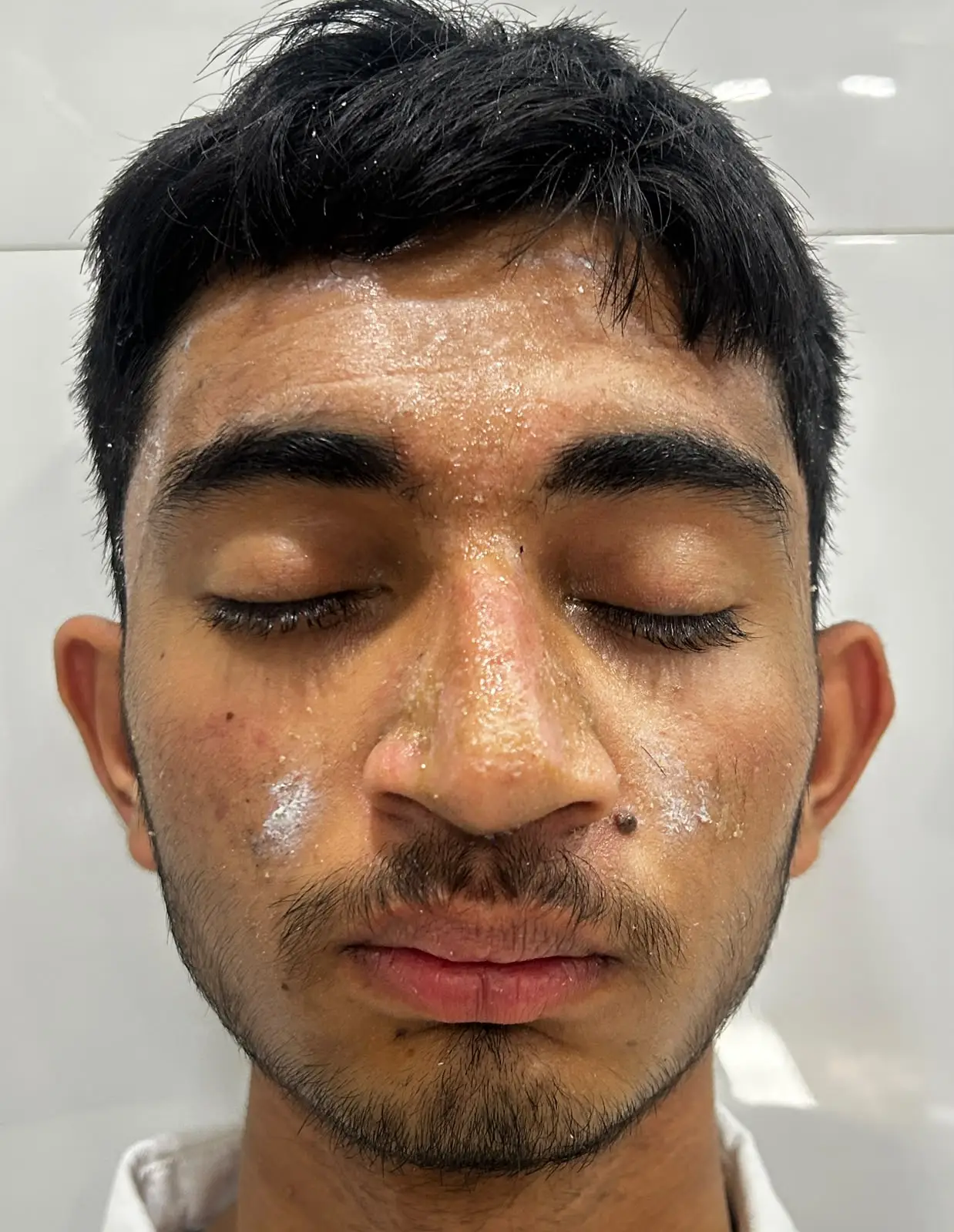 Same patient's face after rhinoplasty, front view