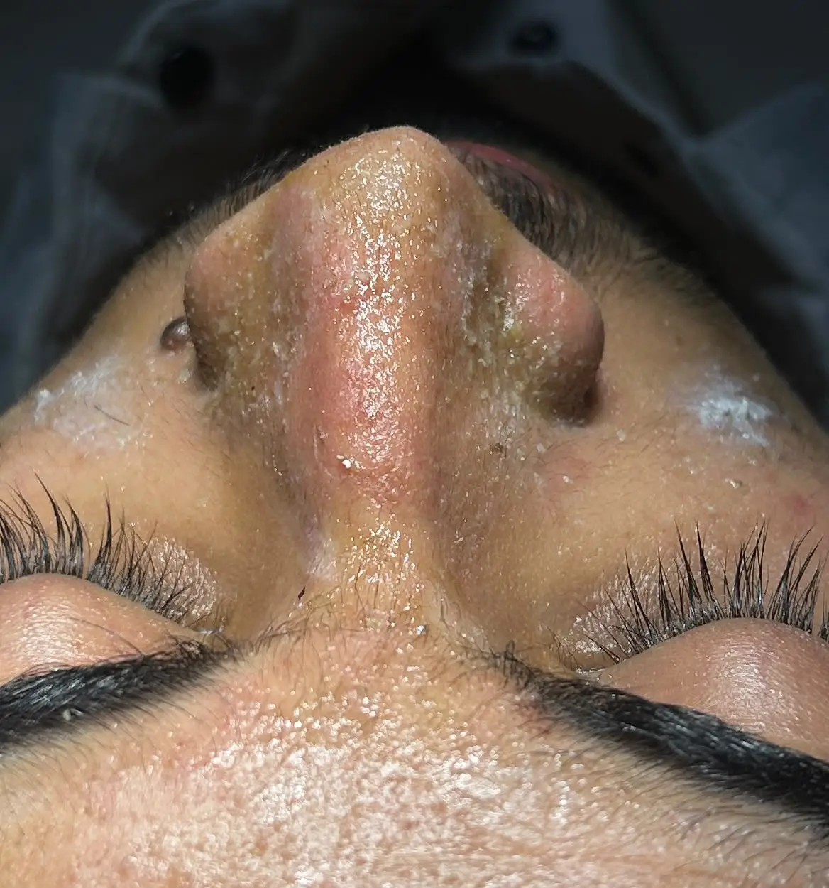Close-up of the same nose immediately after rhinoplasty