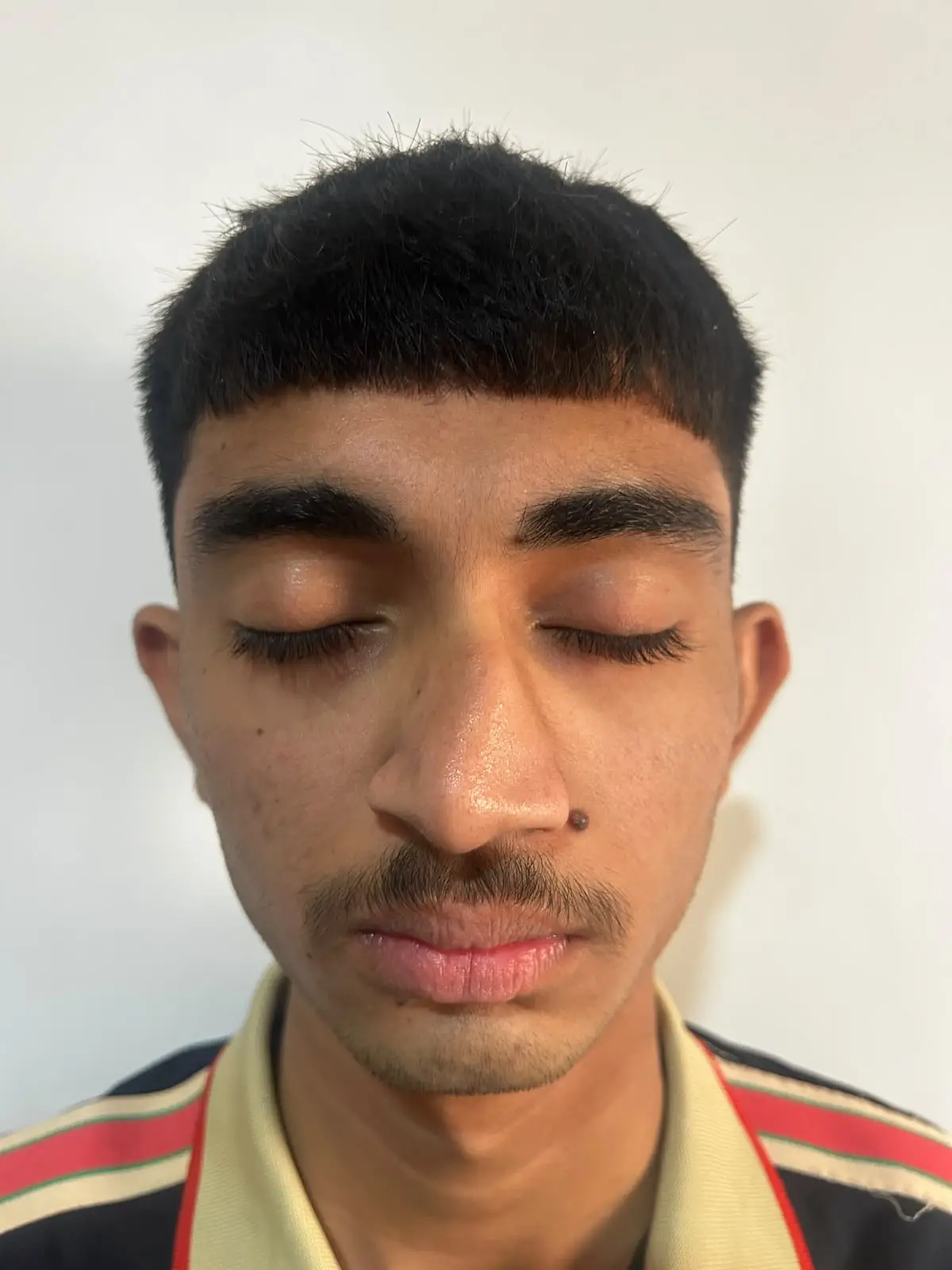 Patient's face before rhinoplasty, front view – rhinoplasty patient