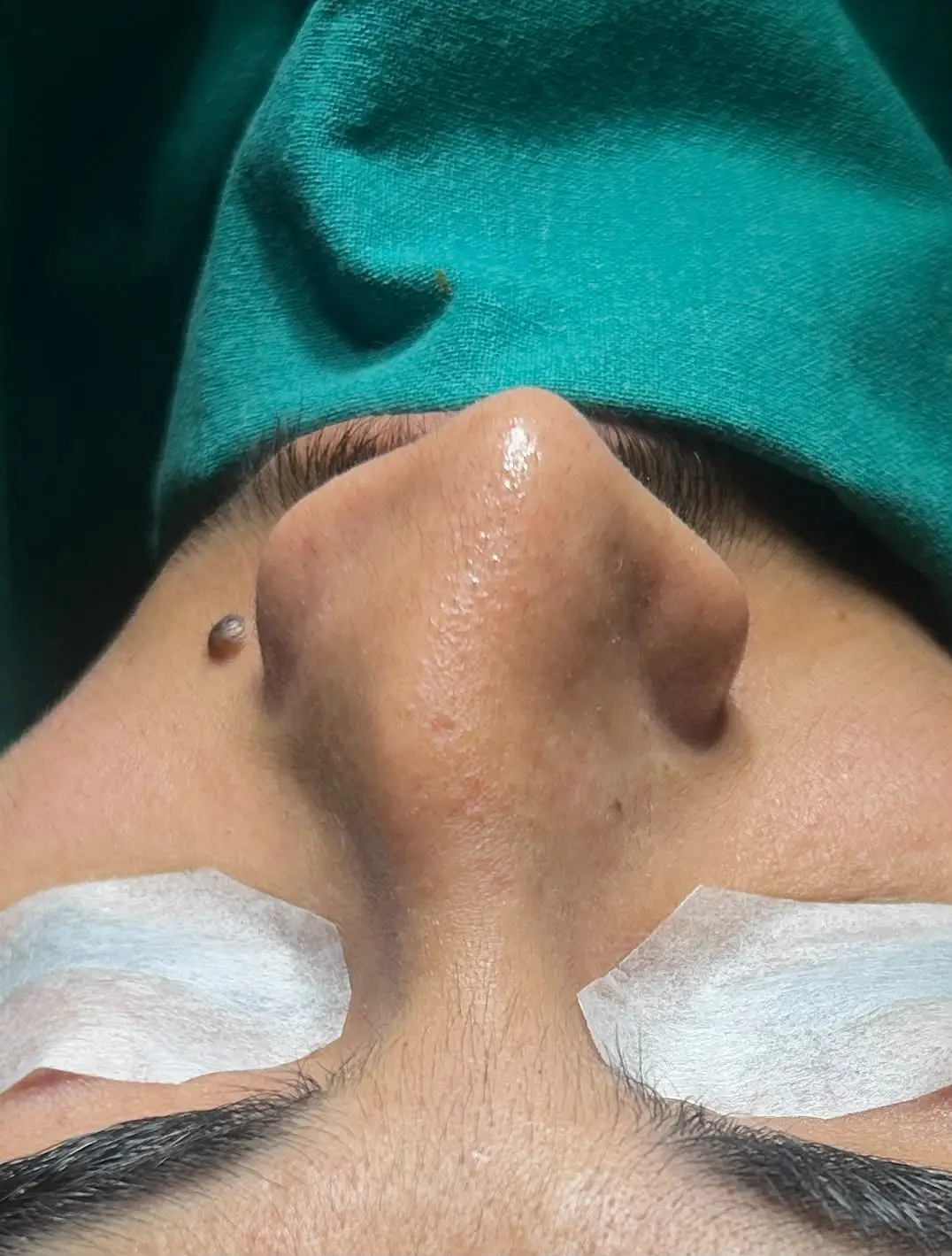 Close-up of the nose just before rhinoplasty