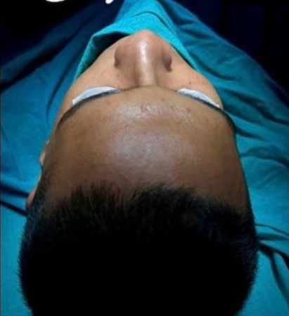 Patient before rhinoplasty surgery with Dr Manali Kakadia