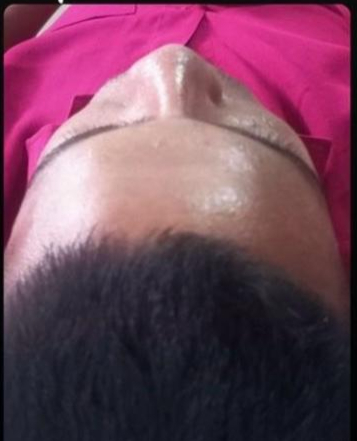 Same patient after rhinoplasty surgery