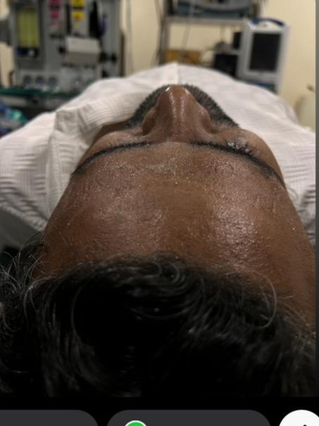 Same patient after rhinoplasty