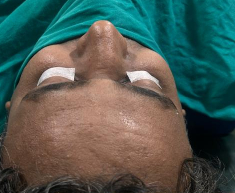 Patient before rhinoplasty with Dr Manali Kakadia