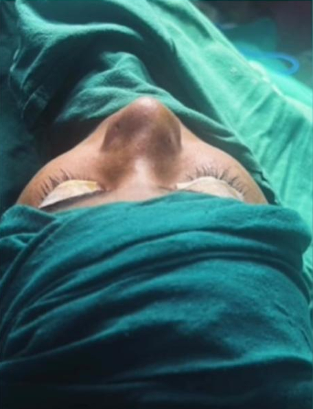 Female patient before rhinoplasty with Dr Manali Kakadia