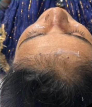 Same patient after rhinoplasty
