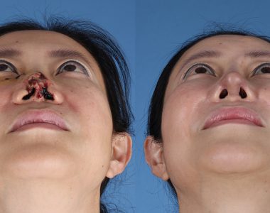 Congenital-Nose-Deformity-Correction