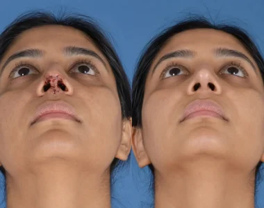 Reconstructive rhinoplasty assessment for nasal deformity and support