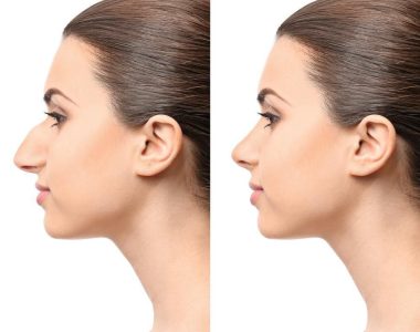 Crooked Nose Correction
