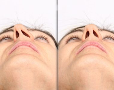 Deviated Septum Treatment
