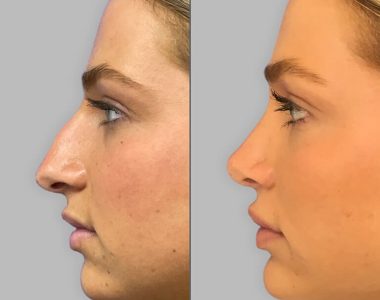 functional-rhinoplasty-surgery