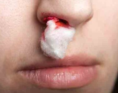 Nose Bleeding Treatment
