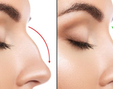Nose Hump Reduction​