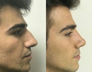 Nose Reshaping Surgery
