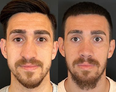 rhinoplasty-surgery-before-after