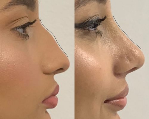 Rhinoplasty Patient