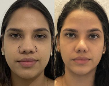 wide-nose-correction